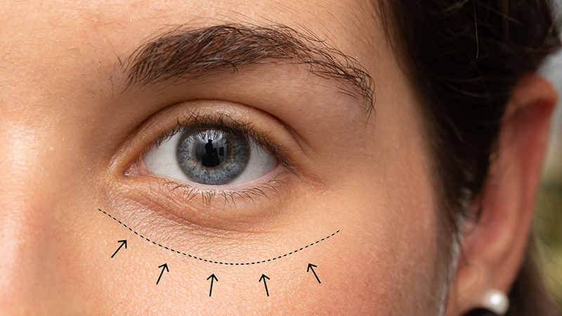 What is Oculoplastic Surgery?